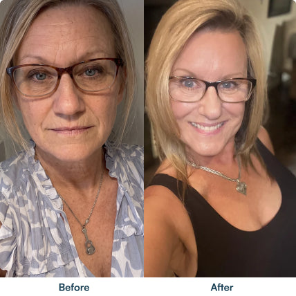Before and after skin photographs
