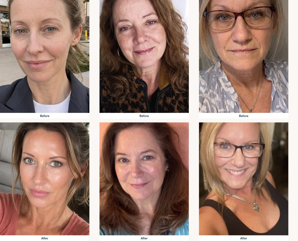 Before and after results: three women, firmer and smoother skin