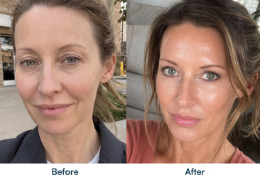 Before and after skin photographs